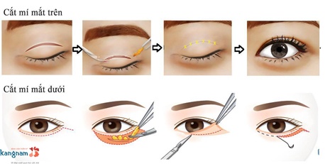 quy trình cắt mí mắt 3
