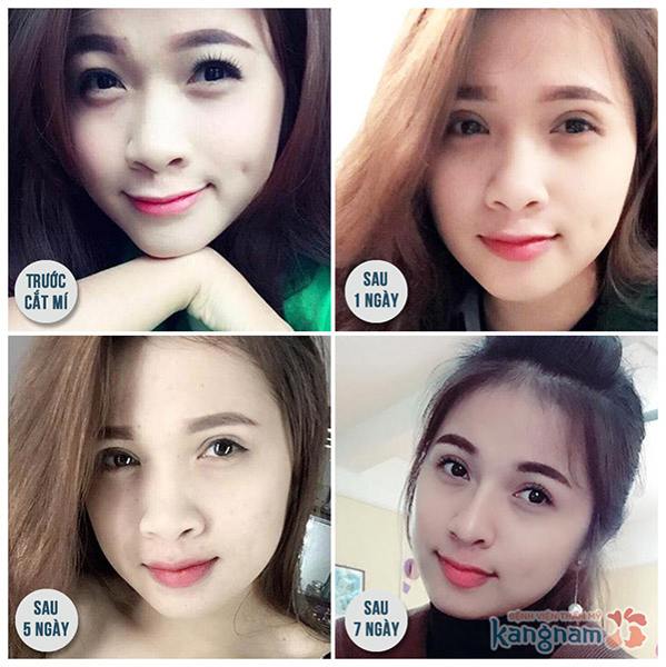 cách làm mắt 2 mí đẹp tự nhiên không cần phẫu thuật 2