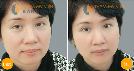 Cắt mí mắt sau bao lâu thì hết sưng?1
