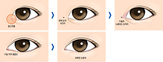 Phẫu thuật mở rộng góc mắt trong tạo mắt to tròn cuốn hút 8
