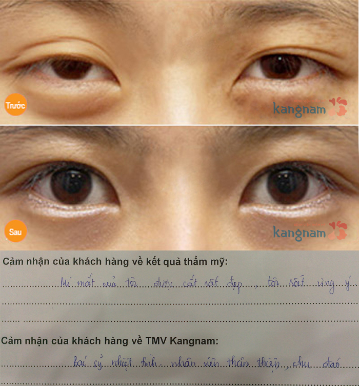 Cách chữa bọng mỡ mắt dưới NHANH và HIỆU QUẢ nhất 7