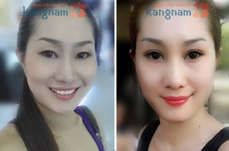 Chị Trần Như Ngọc thay đổi như thế nào sau chỉnh sửa mắt sụp mí tại Kangnam?