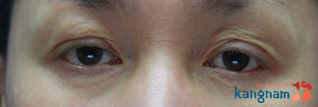 phẫu thuật lấy mỡ mí mắt và cắt da thừa 1