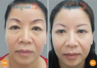 Chia sẻ kết quả cắt da thừa mí mắt tại BVTM Kangnam