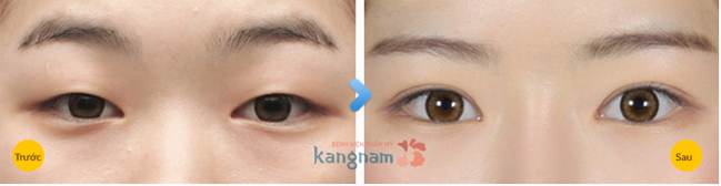 Kết quả thẩm mỹ mắt to tại Kangnam