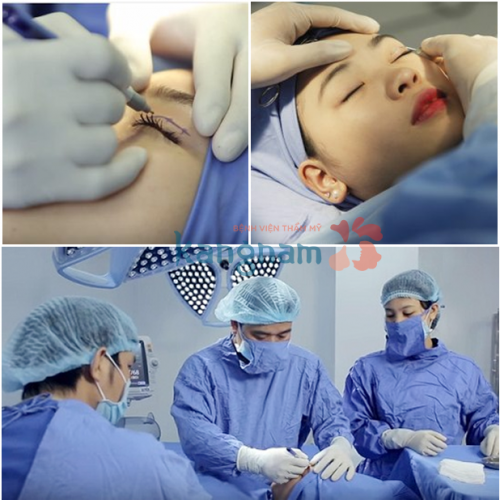 Quy trình phẫu thuật mắt to tại Kangnam