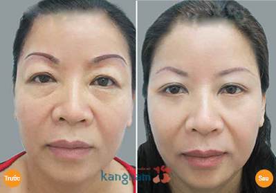 Khách hàng Kangnam trẻ trung hơn sau nâng chân mày có phun xăm