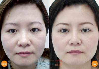 Phẫu thuật nâng chân mày có phun xăm giúp bạn trẻ trung hơn