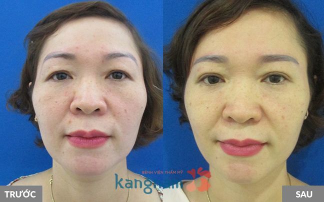 Kết quả nâng chân mày có phun xăm tại Kangnam