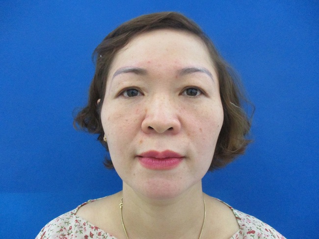 Trường hợp được chỉ định nâng chân mày có phun xăm