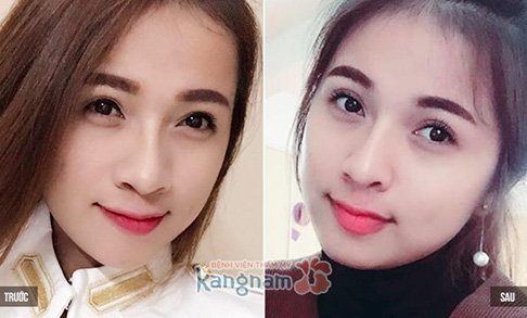 Bạn Thiên Hương chia sẻ có nên cắt mí mắt không?