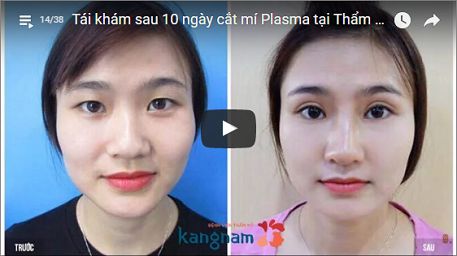 Biến mắt mí lót thành mắt 2 mí vĩnh viễn với bí quyết đơn giản