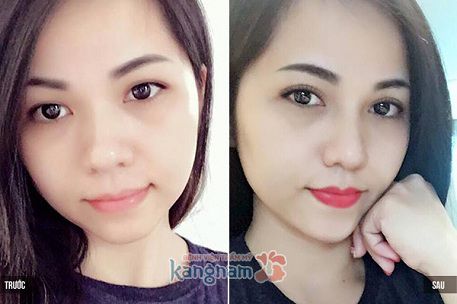 Đôi mắt rạng ngời sau cách kafm mắt 1 mí thành 2 mí tại Kangnam