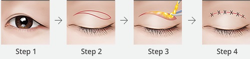Quy trình cắt mí mắt trên tại Kangnam