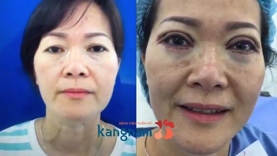 xóa rãnh lệ 8
