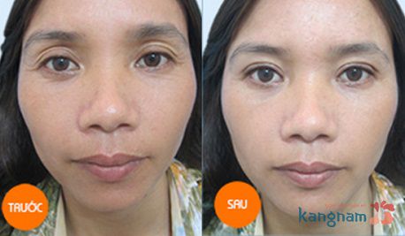 Khắc phục mắt nhiều mí 8