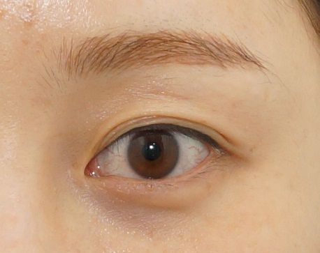 Khắc phục mắt nhiều mí 2