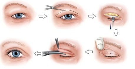Chữa sụp mí mắt có nguy hiểm không2