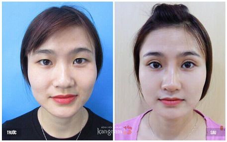 có nên cắt mí mắt không 4