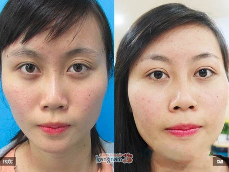 có nên cắt mí mắt không 2