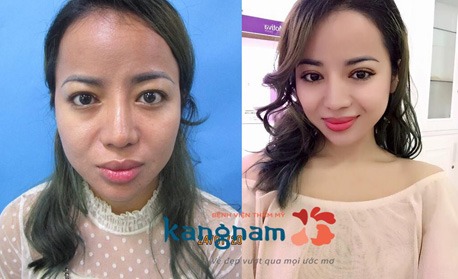 có nên cắt mí mắt không 1