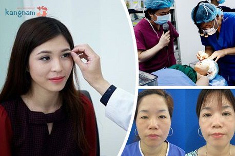 Mắt có nhiều da chùng phải làm sao để khắc phục hoàn toàn3