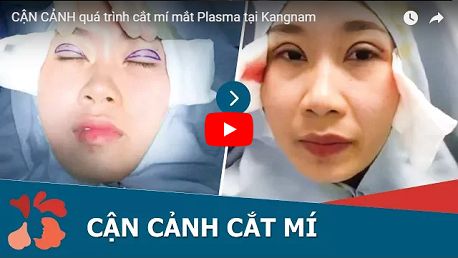 Mách bạn cách tìm địa chỉ cắt mí mắt tin cậy ở Hà Nội