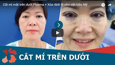 Mắt có nhiều da chùng phải làm sao để khắc phục hoàn toàn