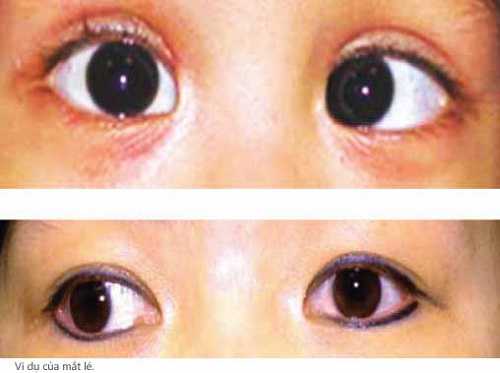 cách chữa mắt lác ở người lớn