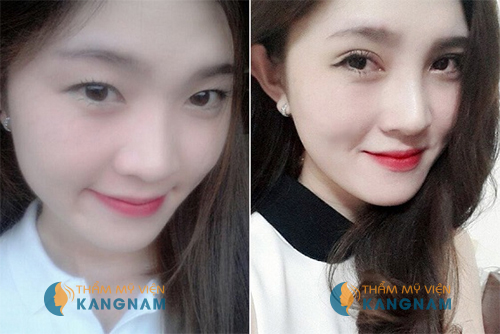 Bấm mí mắt Dove Eyes Hàn Quốc tạo mắt 2 mí đẹp vĩnh viễn88999