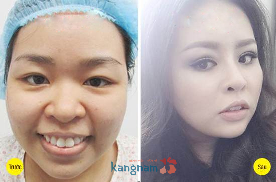 Hình ảnh trước và sau cắt mí mắt, bấm mí mắt Hàn Quốc11