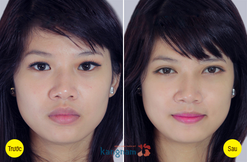 Hình ảnh trước và sau cắt mí mắt, bấm mí mắt Hàn Quốc778