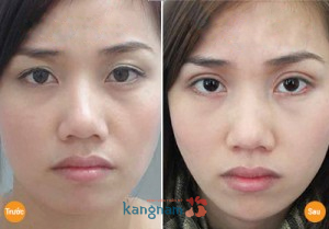 Hình ảnh trước và sau cắt mí mắt, bấm mí mắt Hàn Quốc889