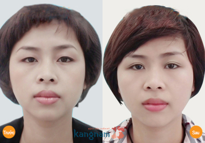 Hình ảnh trước và sau cắt mí mắt, bấm mí mắt Hàn Quốc789