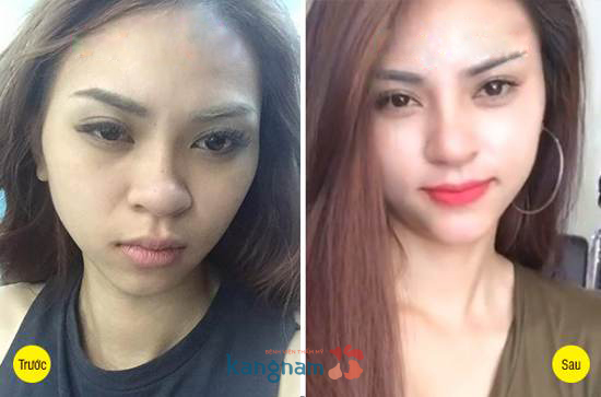 Hình ảnh trước và sau cắt mí mắt, bấm mí mắt Hàn Quốc779
