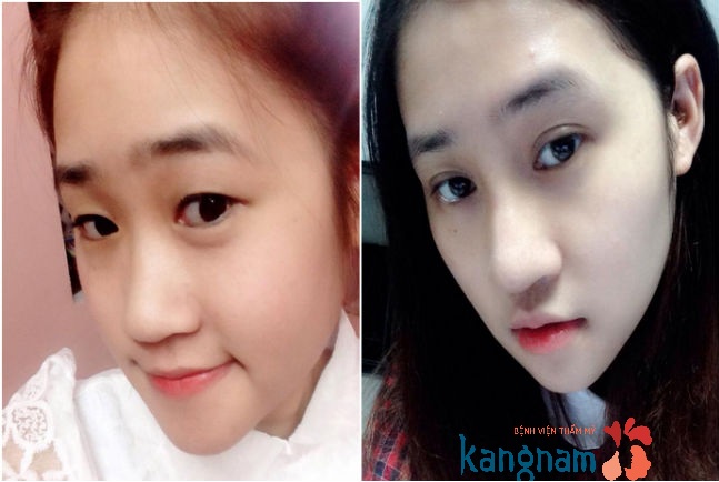 Hình ảnh trước và sau cắt mí mắt, bấm mí mắt Hàn Quốc889