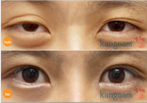 Hình ảnh trước và sau cắt mí mắt890