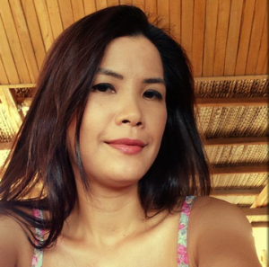 Trường hợp có bọng mỡ mí trên thì nên cắt mí hay lấy mỡ mí mắt?