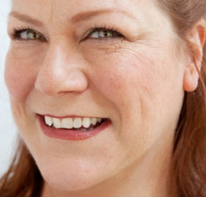 Loại bỏ da mắt bị chùng bằng phương pháp nào?