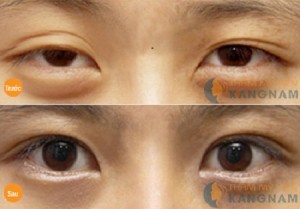 Liệu sau khi cắt mí mắt có để lại sẹo không?