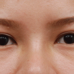 Mắt nhiều mí phải làm sao để khắc phục hiệu quả?