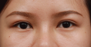 Mắt nhiều mí phải làm sao để khắc phục hiệu quả?