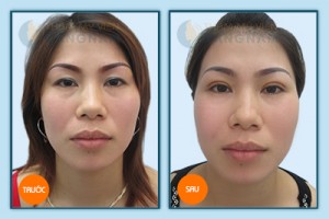 Cắt mí mắt dưới theo CN Hàn Quốc áp dụng cho những trường hợp nào?