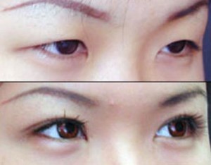 Có nên bấm mí mắt Hàn Quốc hay không?