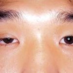 Giải phẫu thẩm mỹ mắt sụp mí có để lại sẹo không?