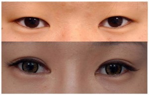 Thẩm mỹ mắt 2 mí có tốn kém lắm không?