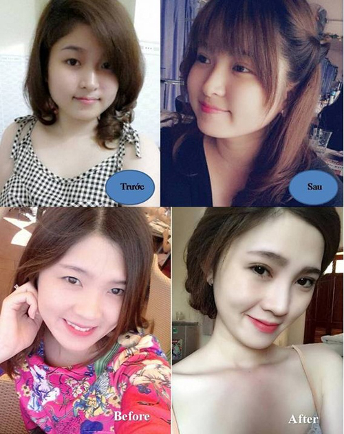 Mắt to hơn với keo tạo mắt 2 mí nhanh hiệu quả123