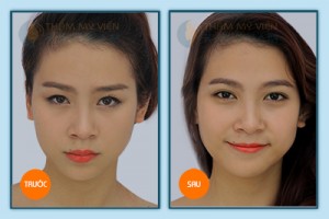 Nhấn mí mắt không cần phẫu thuật phải không?