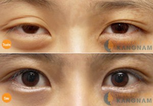 Địa chỉ cắt mí mắt công nghệ Hàn Quốc đẹp nhất tại Hà Nội?