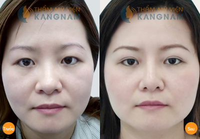 Địa chỉ thẩm mỹ mắt uy tín chuẩn Hàn ngay tại Việt Nam9000